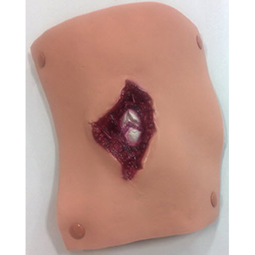 Compound Fracture Humerus Bleeding Moulage